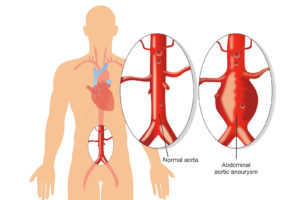 Abdominal aortic