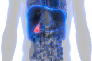 gallstones