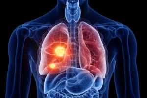 lung